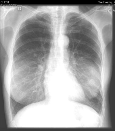 Capa da noticia Monitoramento de O2 no tratamento de enfisema pulmonar é o 1º projeto-piloto de IoT aprovado pelo BNDES